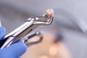 Tooth Extractions in Mesa, AZ Dr. Julee Weidner