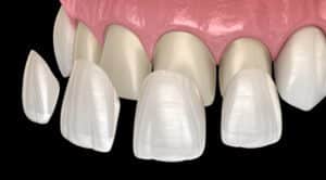 Porcelain Veneers in Mesa Dental Care of Mesa dentist in Mesa, AZ Dr. Julee Weidner