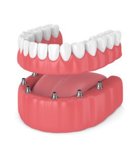 fixed dentures in mesa Dental Care of Mesa dentist in Mesa, AZ Dr. Julee Weidner