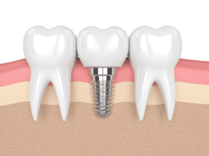 restorative dentistry dental care of mesa dentist in mesa az